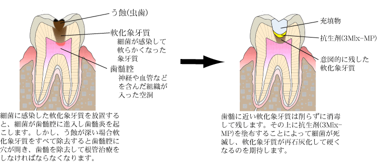 練馬(豊島園)の歯医者、コーナス歯科クリニックのむし歯治療