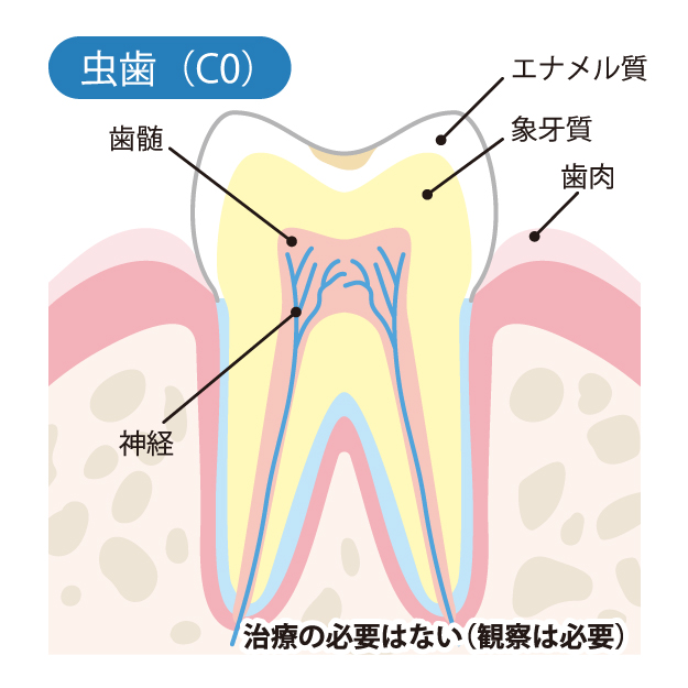 練馬(豊島園)の歯医者、コーナス歯科クリニックのむし歯治療